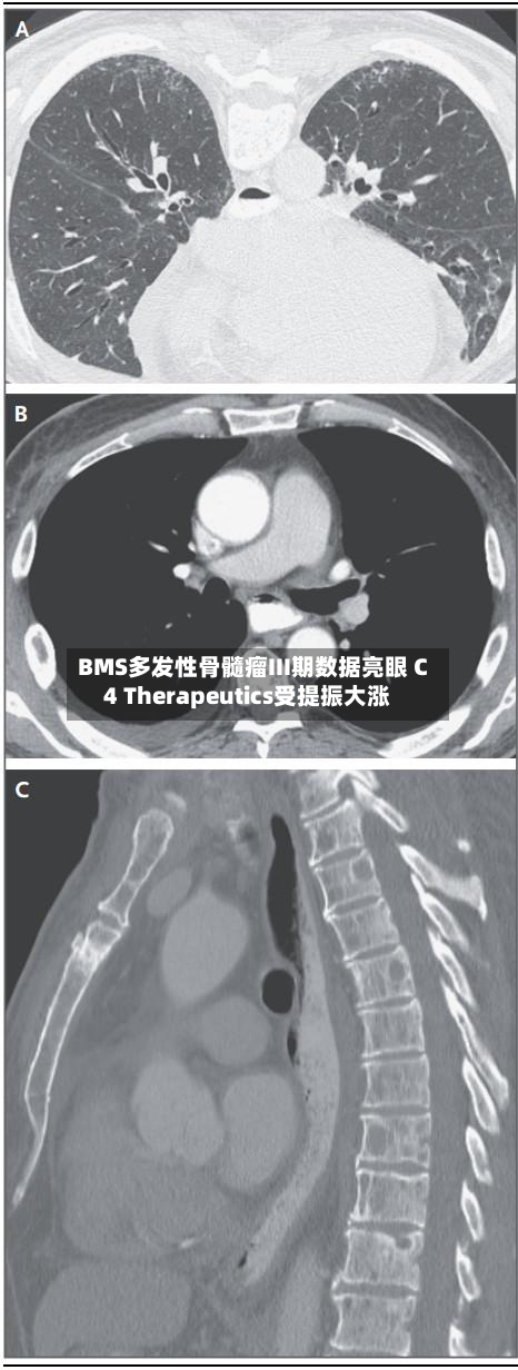 BMS多发性骨髓瘤III期数据亮眼 C4 Therapeutics受提振大涨